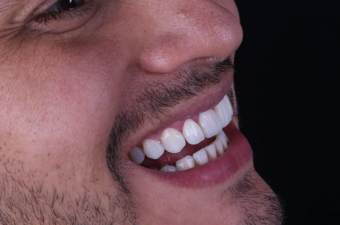 facetas e lente dental utimura odontologia granja viana cotia
